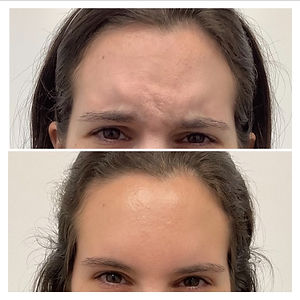 DAXXIFY vs BOTOX Cost Effectiveness | Price Per Unit & More